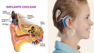 IMPLANTE COCLEAR
 