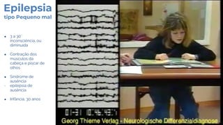 Epilepsia
tipo Pequeno mal
● 3 a 30´´
inconsciência, ou
diminuída
● Contração dos
músculos da
cabeça e piscar de
olhos
● Síndrome de
ausência
- epilepsia de
ausência
● Infância, 30 anos
 