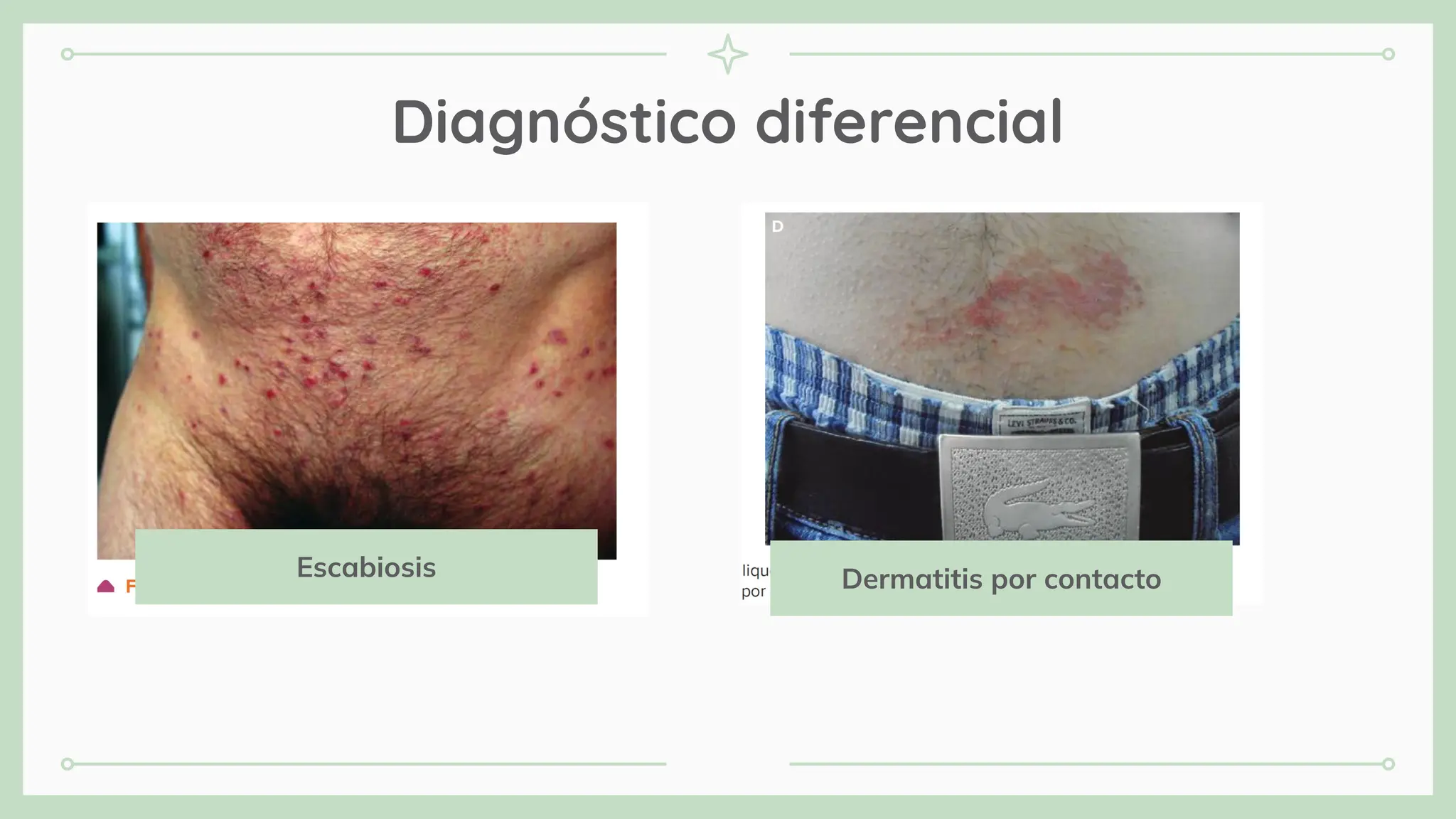 Diagnóstico diferencial
Escabiosis Dermatitis por contacto
 