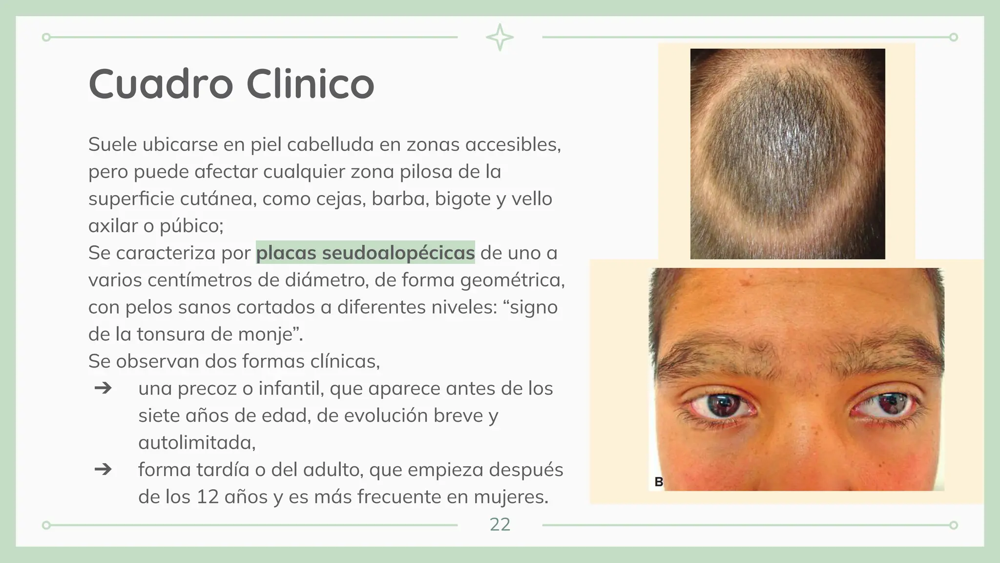 22
Cuadro Clinico
Suele ubicarse en piel cabelluda en zonas accesibles,
pero puede afectar cualquier zona pilosa de la
superﬁcie cutánea, como cejas, barba, bigote y vello
axilar o púbico;
Se caracteriza por placas seudoalopécicas de uno a
varios centímetros de diámetro, de forma geométrica,
con pelos sanos cortados a diferentes niveles: “signo
de la tonsura de monje”.
Se observan dos formas clínicas,
➔ una precoz o infantil, que aparece antes de los
siete años de edad, de evolución breve y
autolimitada,
➔ forma tardía o del adulto, que empieza después
de los 12 años y es más frecuente en mujeres.
 