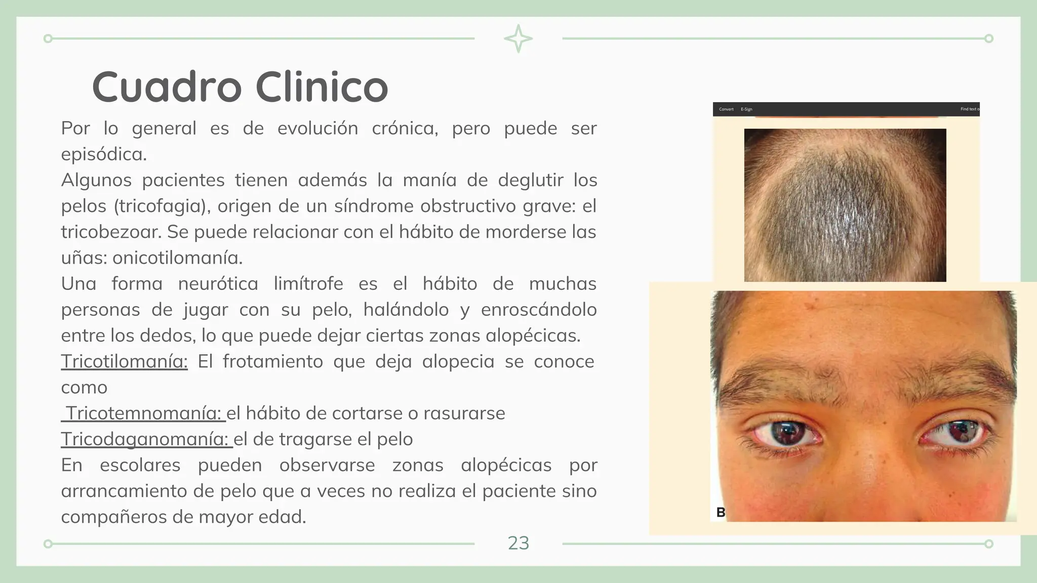 23
Cuadro Clinico
Por lo general es de evolución crónica, pero puede ser
episódica.
Algunos pacientes tienen además la manía de deglutir los
pelos (tricofagia), origen de un síndrome obstructivo grave: el
tricobezoar. Se puede relacionar con el hábito de morderse las
uñas: onicotilomanía.
Una forma neurótica limítrofe es el hábito de muchas
personas de jugar con su pelo, halándolo y enroscándolo
entre los dedos, lo que puede dejar ciertas zonas alopécicas.
Tricotilomanía: El frotamiento que deja alopecia se conoce
como
Tricotemnomanía: el hábito de cortarse o rasurarse
Tricodaganomanía: el de tragarse el pelo
En escolares pueden observarse zonas alopécicas por
arrancamiento de pelo que a veces no realiza el paciente sino
compañeros de mayor edad.
 
