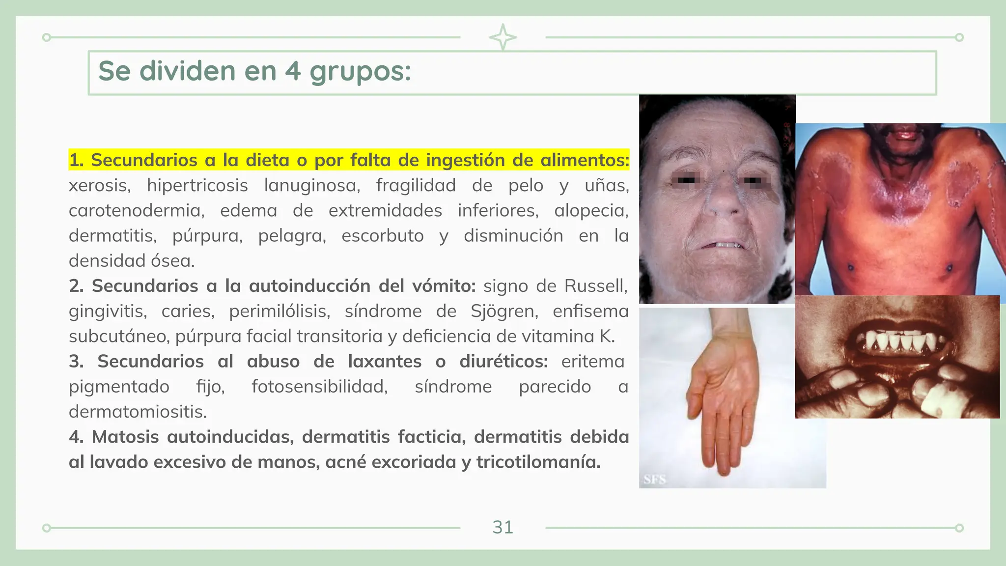 31
1. Secundarios a la dieta o por falta de ingestión de alimentos:
xerosis, hipertricosis lanuginosa, fragilidad de pelo y uñas,
carotenodermia, edema de extremidades inferiores, alopecia,
dermatitis, púrpura, pelagra, escorbuto y disminución en la
densidad ósea.
2. Secundarios a la autoinducción del vómito: signo de Russell,
gingivitis, caries, perimilólisis, síndrome de Sjögren, enﬁsema
subcutáneo, púrpura facial transitoria y deﬁciencia de vitamina K.
3. Secundarios al abuso de laxantes o diuréticos: eritema
pigmentado ﬁjo, fotosensibilidad, síndrome parecido a
dermatomiositis.
4. Matosis autoinducidas, dermatitis facticia, dermatitis debida
al lavado excesivo de manos, acné excoriada y tricotilomanía.
Se dividen en 4 grupos:
 