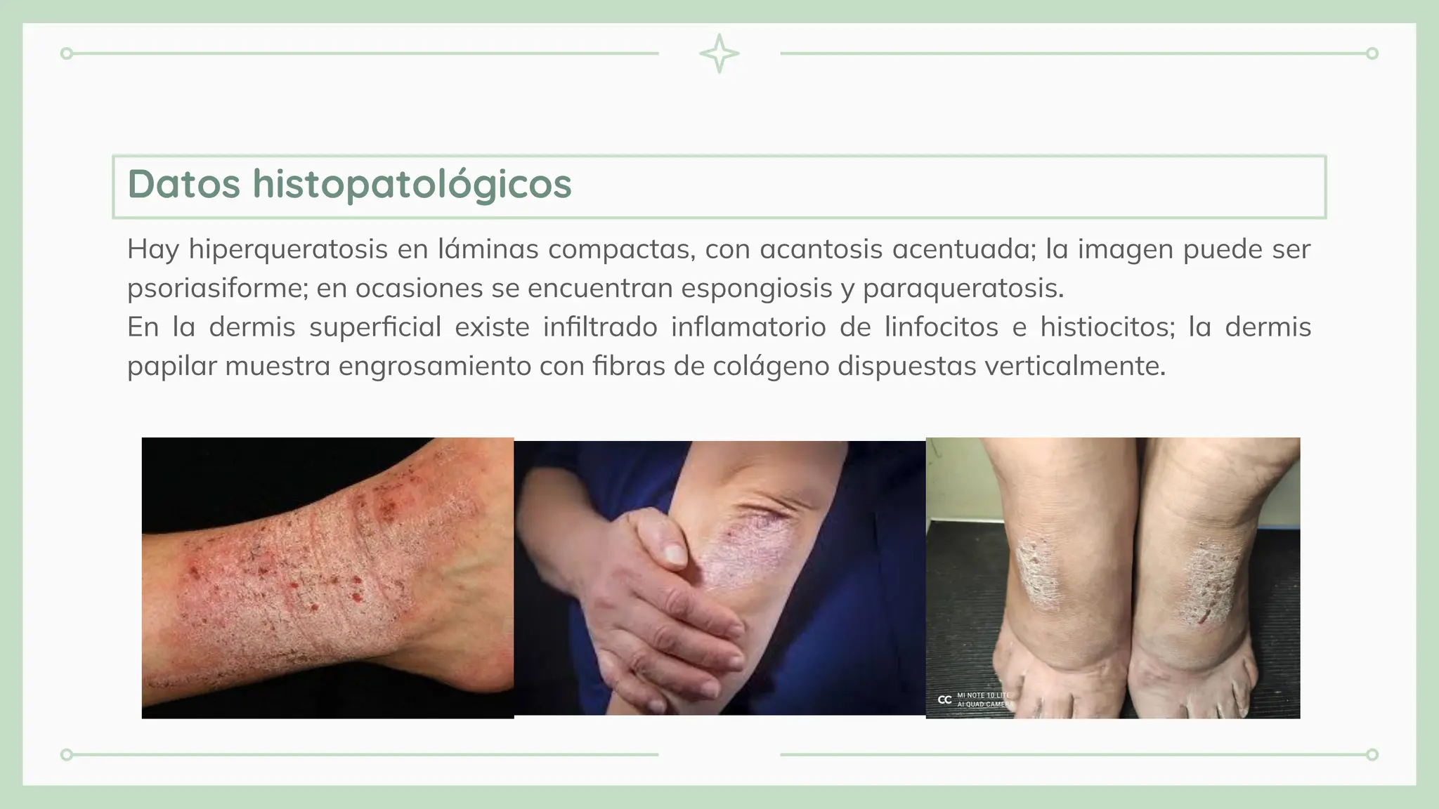 Hay hiperqueratosis en láminas compactas, con acantosis acentuada; la imagen puede ser
psoriasiforme; en ocasiones se encuentran espongiosis y paraqueratosis.
En la dermis superﬁcial existe inﬁltrado inﬂamatorio de linfocitos e histiocitos; la dermis
papilar muestra engrosamiento con ﬁbras de colágeno dispuestas verticalmente.
Datos histopatológicos
 