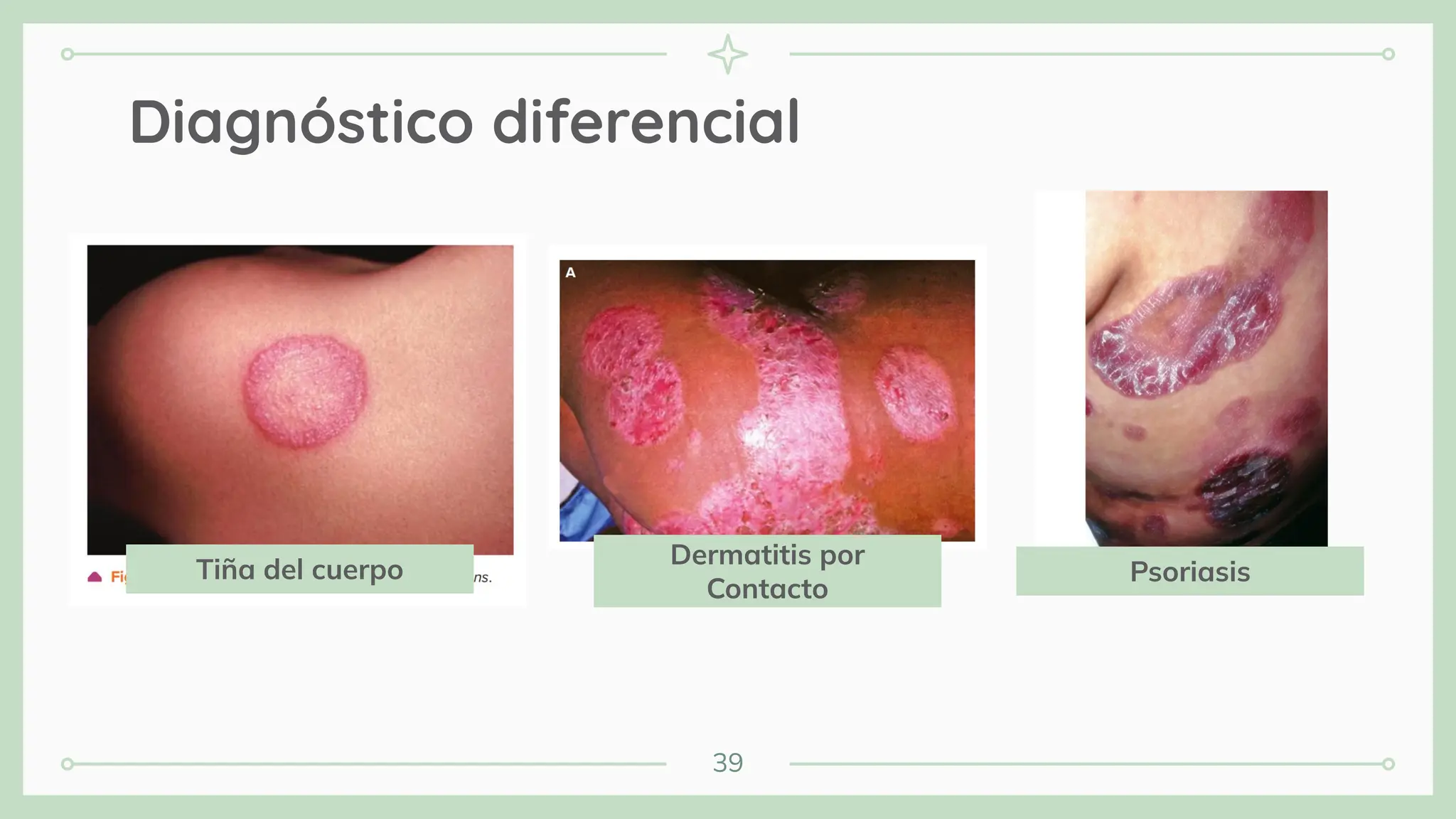 39
Diagnóstico diferencial
Tiña del cuerpo
Dermatitis por
Contacto
Psoriasis
 