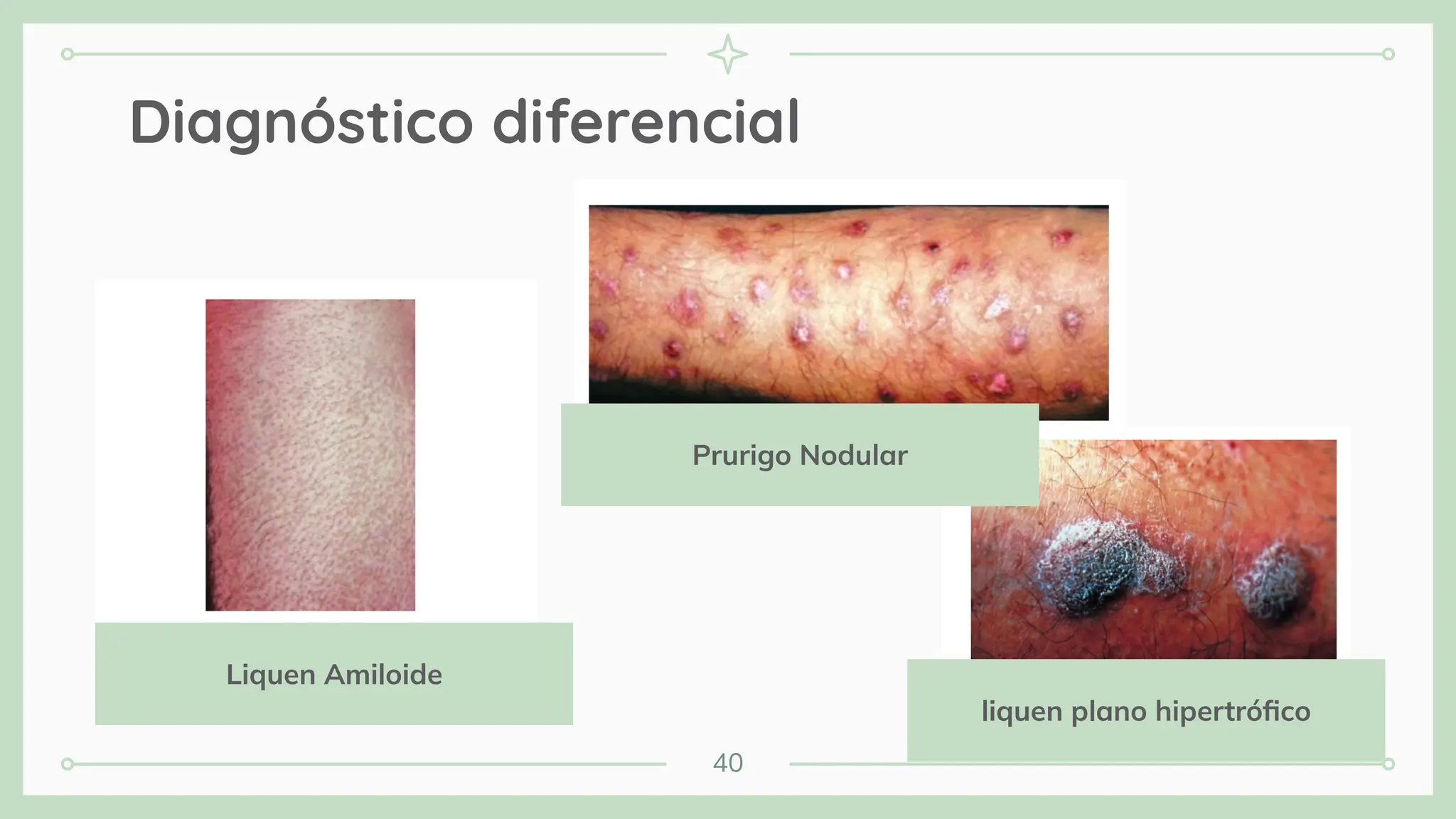 40
Diagnóstico diferencial
liquen plano hipertróﬁco
Prurigo Nodular
Liquen Amiloide
 