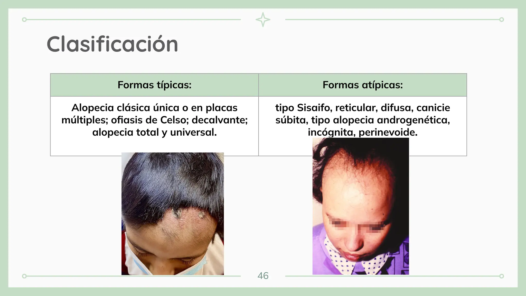 46
Clasiﬁcación
Formas típicas: Formas atípicas:
Alopecia clásica única o en placas
múltiples; oﬁasis de Celso; decalvante;
alopecia total y universal.
tipo Sisaifo, reticular, difusa, canicie
súbita, tipo alopecia androgenética,
incógnita, perinevoide.
 