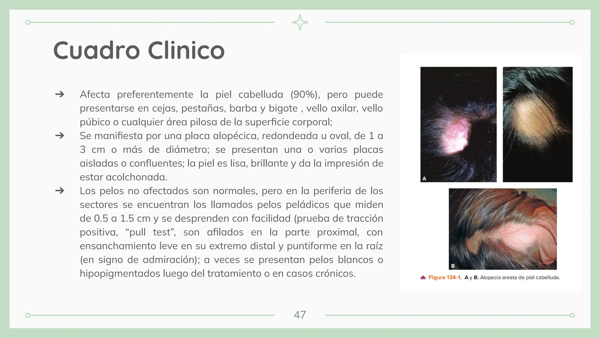 47
Cuadro Clinico
➔ Afecta preferentemente la piel cabelluda (90%), pero puede
presentarse en cejas, pestañas, barba y bigote , vello axilar, vello
púbico o cualquier área pilosa de la superﬁcie corporal;
➔ Se maniﬁesta por una placa alopécica, redondeada u oval, de 1 a
3 cm o más de diámetro; se presentan una o varias placas
aisladas o conﬂuentes; la piel es lisa, brillante y da la impresión de
estar acolchonada.
➔ Los pelos no afectados son normales, pero en la periferia de los
sectores se encuentran los llamados pelos peládicos que miden
de 0.5 a 1.5 cm y se desprenden con facilidad (prueba de tracción
positiva, “pull test”, son aﬁlados en la parte proximal, con
ensanchamiento leve en su extremo distal y puntiforme en la raíz
(en signo de admiración); a veces se presentan pelos blancos o
hipopigmentados luego del tratamiento o en casos crónicos.
 
