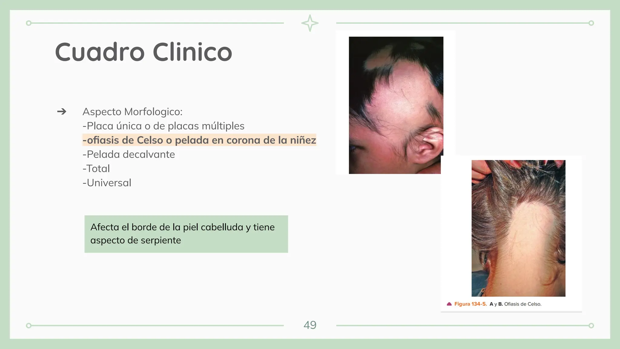 49
Cuadro Clinico
➔ Aspecto Morfologico:
-Placa única o de placas múltiples
-oﬁasis de Celso o pelada en corona de la niñez
-Pelada decalvante
-Total
-Universal
Afecta el borde de la piel cabelluda y tiene
aspecto de serpiente
 