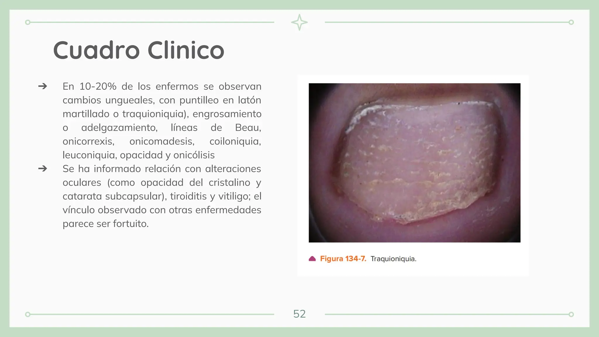 52
Cuadro Clinico
➔ En 10-20% de los enfermos se observan
cambios ungueales, con puntilleo en latón
martillado o traquioniquia), engrosamiento
o adelgazamiento, líneas de Beau,
onicorrexis, onicomadesis, coiloniquia,
leuconiquia, opacidad y onicólisis
➔ Se ha informado relación con alteraciones
oculares (como opacidad del cristalino y
catarata subcapsular), tiroiditis y vitiligo; el
vínculo observado con otras enfermedades
parece ser fortuito.
 