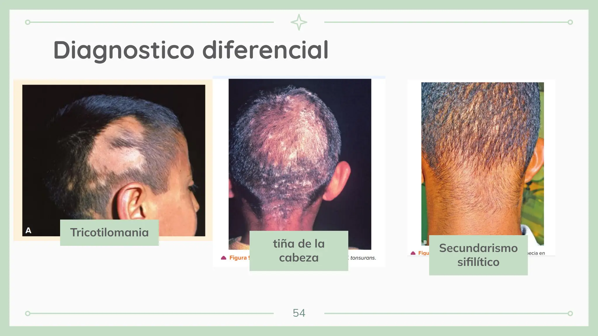 54
Diagnostico diferencial
Tricotilomania
tiña de la
cabeza
Secundarismo
siﬁlítico
 