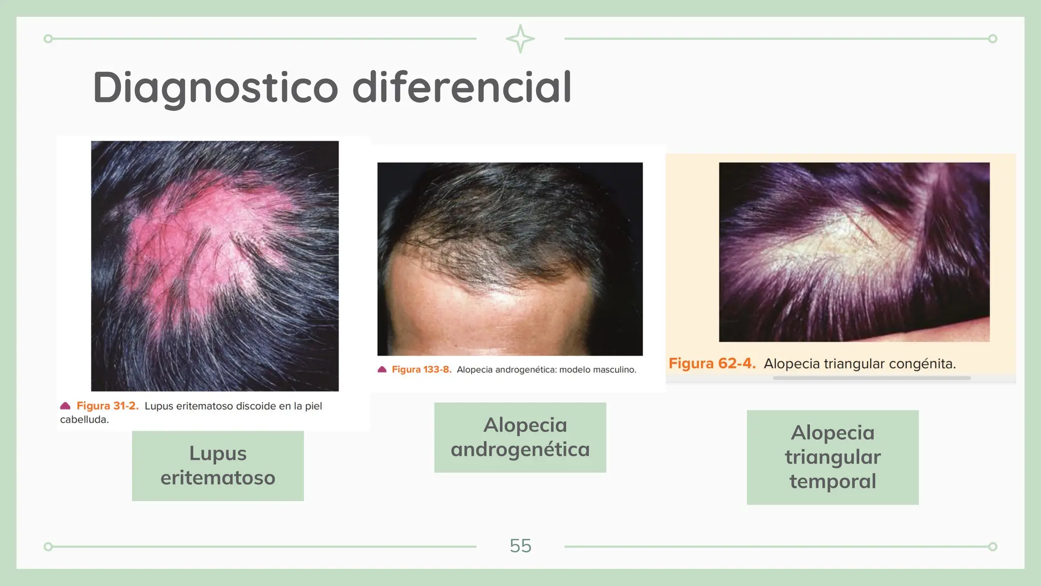 55
Diagnostico diferencial
Lupus
eritematoso
Alopecia
androgenética
Alopecia
triangular
temporal
 
