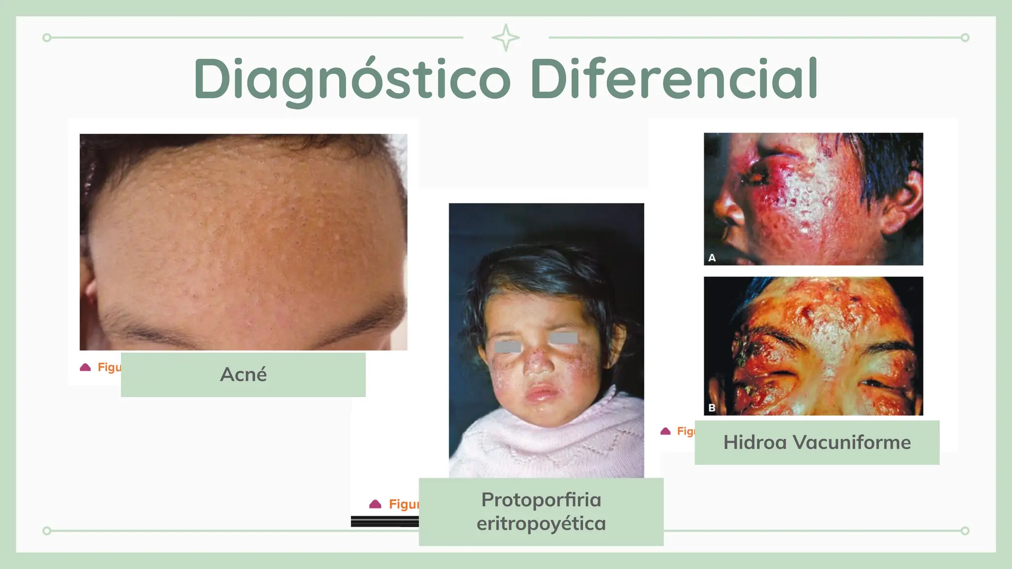 Diagnóstico Diferencial
Big numbers catch your audience’s attention
8
Acné
Hidroa Vacuniforme
Protoporﬁria
eritropoyética
 