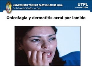 Onicofagia y dermatitis acral por lamido 