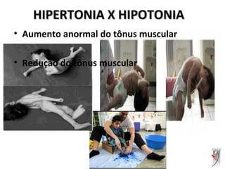 HIPERTONIA X HIPOTONIAHIPERTONIA X HIPOTONIA
• Aumento anormal do tônus muscular
• Redução do tônus muscular
 