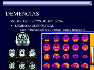 DEMENCIAS MODELOS CLÍNICOS DE DEMENCIA DEMENCIA SUBCORTICAL Ejemplo: Demencia de fronto-temporal (paciente femenino 53 a.) 