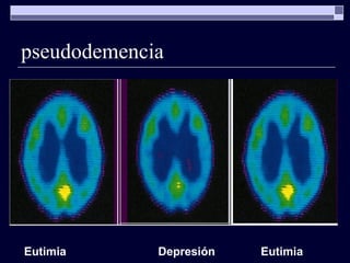 pseudodemencia Eutimia Depresión Eutimia 