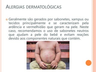 ALERGIAS DERMATOLÓGICAS
 Geralmente são gerados por sabonetes, xampus ou
tecidos principalmente e se caracterizam pela
ardência e vermelhidão que geram na pele. Neste
caso, recomendamos o uso de sabonetes neutros
que ajudam a pele do bebê e evitam reações
devido aos componentes naturais que contém.
 