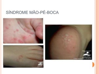 SÍNDROME MÃO-PÉ-BOCA
 