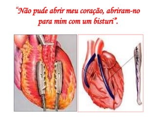 “Não pude abrir meu coração, abriram-no
para mim com um bisturi”.
 