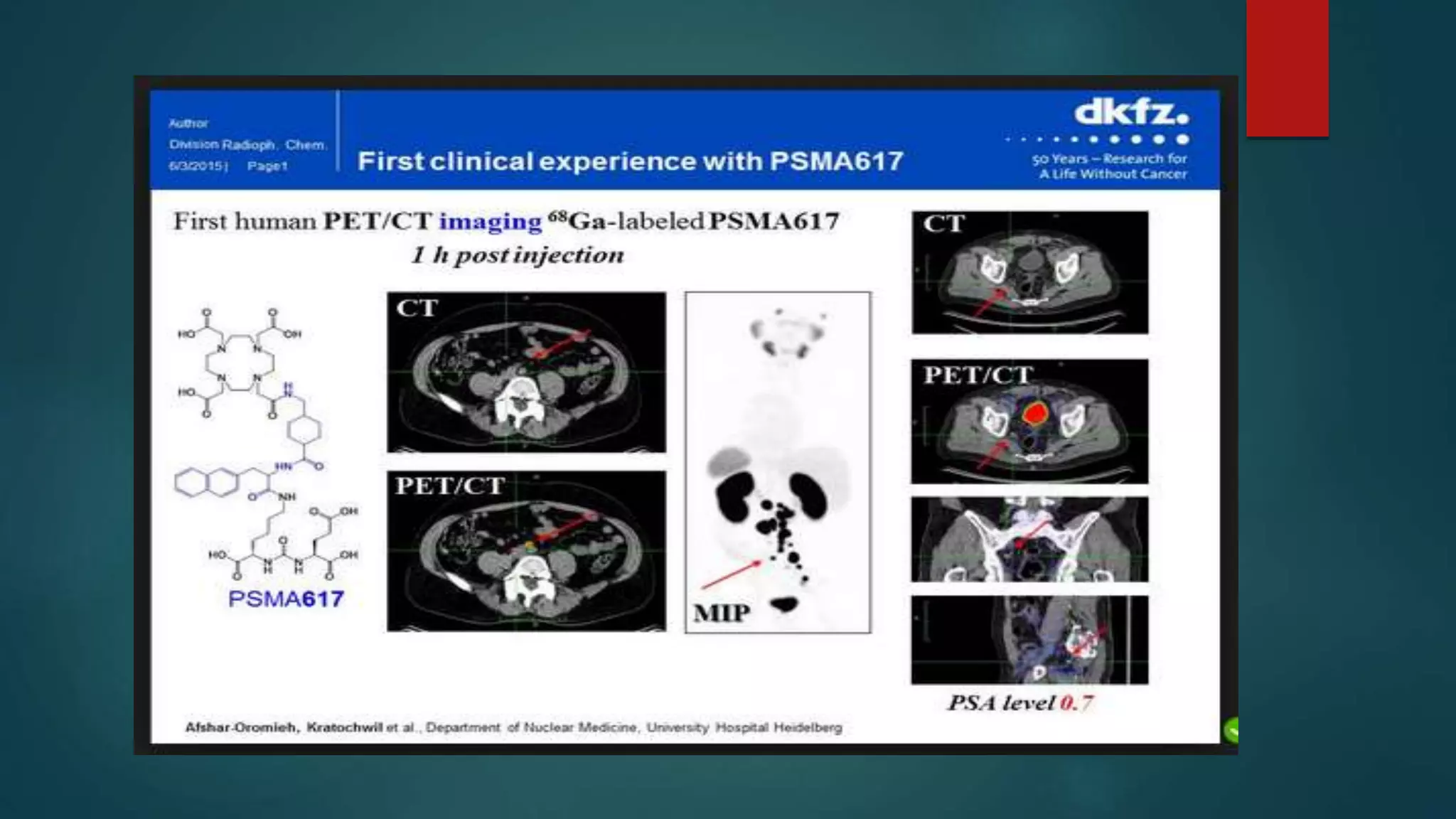 PSMA pet ct scan | PPTX