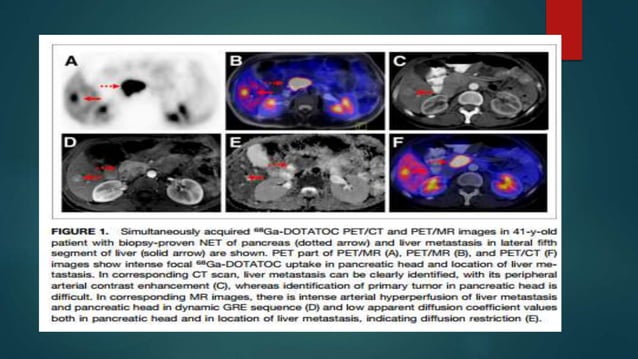 PSMA pet ct scan | PPTX | Cancer | Diseases and Conditions