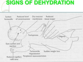 SIGNS OF DEHYDRATION
 
