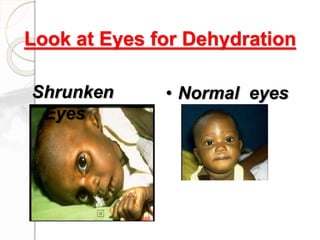Look at Eyes for Dehydration
Shrunken
Eyes
• Normal eyes
 