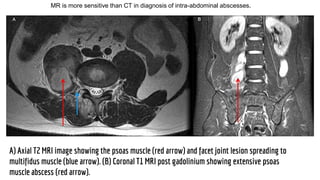 A) Axial T2 MRI image showing the psoas muscle (red arrow) and facet joint lesion spreading to
multifidus muscle (blue arrow). (B) Coronal T1 MRI post gadolinium showing extensive psoas
muscle abscess (red arrow).
MR is more sensitive than CT in diagnosis of intra-abdominal abscesses.
 