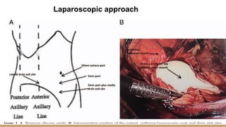 Laparoscopic approach
 