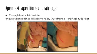 Open extraperitoneal drainage
● Through lateral loin incision
Psoas region reached extraperitoneally .Pus drained – drainage tube kept
 
