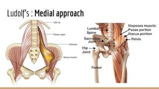 Ludolf’s : Medial approach
 