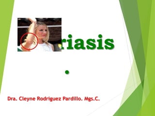 Psoriasis
.
Dra. Cleyne Rodriguez Pardillo. Mgs.C.
 