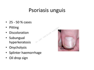 Psoriasis unguis
• 25 - 50 % cases
• Pitting
• Discoloration
• Subungual
hyperkeratosis
• Onycholysis
• Splinter haemorrhage
• Oil drop sign
 