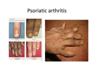 Psoriatic arthritis
 