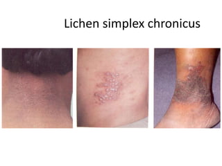 Lichen simplex chronicus
 