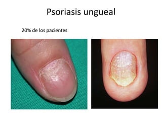Psoriasis ungueal
20% de los pacientes
 