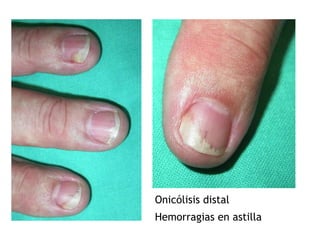 Onicólisis distal
Hemorragias en astilla
 