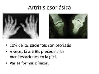 Artritis psoriásica




• 10% de los pacientes con psoriasis
• A veces la artritis precede a las
  manifestaciones en la piel.
• Varias formas clínicas.
 