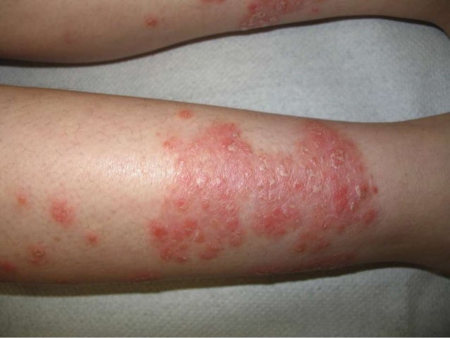 El ungüento de la psoriasis público