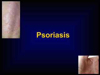 Psoriasis   