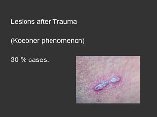 Lesions after Trauma  (Koebner phenomenon) 30 % cases. 