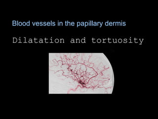 Blood vessels in the papillary dermis  Dilatation and tortuosity 
