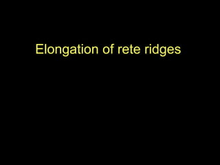Elongation of rete ridges   