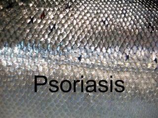 Psoriasis 