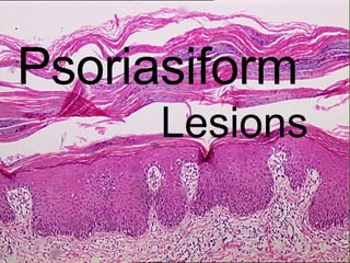 Psoriasiform   Lesions 