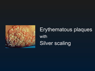 <ul><li>Erythematous plaques  </li></ul><ul><li>with   </li></ul><ul><li>Silver scaling  </li></ul>
