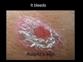 <ul><li>Auspitz’s sign </li></ul>It bleeds  