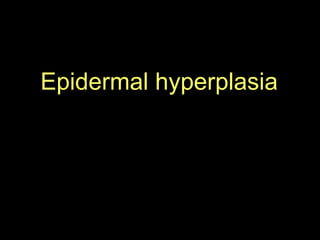 Epidermal hyperplasia   