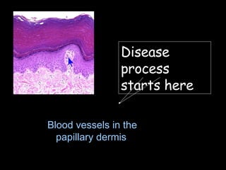 Blood vessels in the papillary dermis  Disease process starts here   