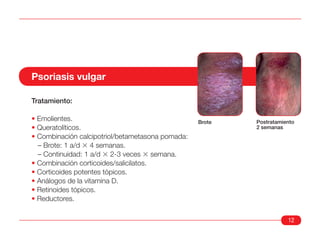 Psoriasis vulgar

Tratamiento:

• Emolientes.                                     Brote   Postratamiento
• Queratolíticos.                                         2 semanas
• Combinación calcipotriol/betametasona pomada:
  – Brote: 1 a/d 3 4 semanas.
  – Continuidad: 1 a/d 3 2-3 veces 3 semana.
• Combinación corticoides/salicilatos.
• Corticoides potentes tópicos.
• Análogos de la vitamina D.
• Retinoides tópicos.
• Reductores.

                                                                     12
 